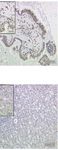 G Protein-Coupled Estrogen Receptor Correlates With Dkk2 Expression and Has Prognostic Impact in Ovarian Cancer Patients - Frontiers