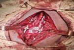 Outcome of Surgical Management of Unstable Dorso-Lumbar Spine Injuries with Transpedicular Screws and Rods Fixation with Posterior Decompression
