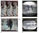 Outcome of Surgical Management of Unstable Dorso-Lumbar Spine Injuries with Transpedicular Screws and Rods Fixation with Posterior Decompression