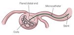 THERAPEUTIC CHALLENGE - Endovascular treatment of wide-neck saccular renal artery aneurysm with waffle-cone technique