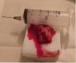 Minimally invasive treatment of gynecomastia by ultrasound-guided vacuum-assisted excision: report of a case series