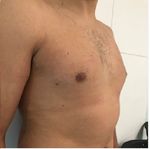 Minimally invasive treatment of gynecomastia by ultrasound-guided vacuum-assisted excision: report of a case series