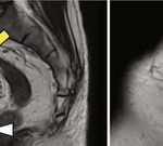 Case Report Management of Groin Pain Using an Iliohypogastric Nerve Block in a Patient with Inguinal Hernia due to Persistent Müllerian Duct Syndrome