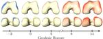 Geodesic B-Score for Improved Assessment of Knee Osteoarthritis