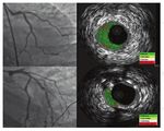 ST-segment elevation myocardial infarction in post-COVID-19 patients: A case series