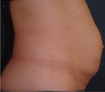 Case Report Correction of Diastasis Rectus Abdominis with Tacking the Rectus Sheath and Resection of Excess Skin for Cosmesis