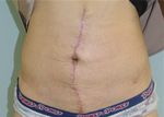 Case Report Correction of Diastasis Rectus Abdominis with Tacking the Rectus Sheath and Resection of Excess Skin for Cosmesis