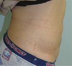 Case Report Correction of Diastasis Rectus Abdominis with Tacking the Rectus Sheath and Resection of Excess Skin for Cosmesis