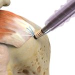Ventix Link Screw-In Knotless Anchor - for Lateral Row Fixation in Rotator Cuff Repair - Zimmer Biomet