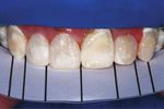 Case Report Cleidocranial Dysplasia Case Report: Remodeling of Teeth as Aesthetic Restorative Treatment - FGM