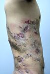 Extensive Nevus Comedonicus with Inflammatory Nodules and Cysts Controlled with Adalimumab