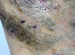Extensive Nevus Comedonicus with Inflammatory Nodules and Cysts Controlled with Adalimumab