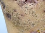 Extensive Nevus Comedonicus with Inflammatory Nodules and Cysts Controlled with Adalimumab