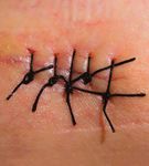 How to Treat WOUND INFECTION - Prevention and treatment Richard Everts - ACC