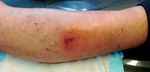 How to Treat WOUND INFECTION - Prevention and treatment Richard Everts - ACC