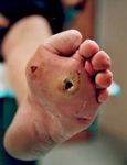 How to Treat WOUND INFECTION - Prevention and treatment Richard Everts - ACC