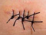 How to Treat WOUND INFECTION - Prevention and treatment Richard Everts - ACC