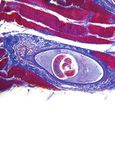 Loxoscelism: Cutaneous and Hematologic Manifestations