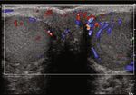 Case Report Metastatic Seminoma with Positive Staining of Cytokeratin and MOC31: A Diagnostic Pitfall