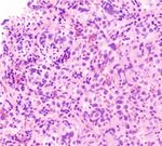 Case Report Metastatic Seminoma with Positive Staining of Cytokeratin and MOC31: A Diagnostic Pitfall
