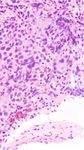 Case Report Metastatic Seminoma with Positive Staining of Cytokeratin and MOC31: A Diagnostic Pitfall