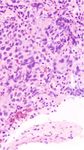 Case Report Metastatic Seminoma with Positive Staining of Cytokeratin and MOC31: A Diagnostic Pitfall