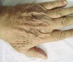 Cryotherapy versus Phenol Chemical Peeling for Solar Lentigines: A Clinical, Histologic, Immunohistochemical and Ultrastructural Study