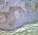Cryotherapy versus Phenol Chemical Peeling for Solar Lentigines: A Clinical, Histologic, Immunohistochemical and Ultrastructural Study
