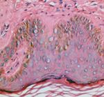 Cryotherapy versus Phenol Chemical Peeling for Solar Lentigines: A Clinical, Histologic, Immunohistochemical and Ultrastructural Study