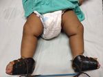 Bilateral idiopathic club foot in baby of a rheumatoid mother: A rare case report and its management - IP ...