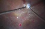 Chandelier endoillumination in Vitreoretinal Surgery