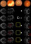 From Patch to Image Segmentation using Fully Convolutional Networks - Application to Retinal Images - arXiv