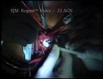 Supra-annular aortic valve replacement with a mechanical prosthesis