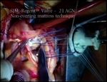 Supra-annular aortic valve replacement with a mechanical prosthesis