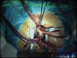 Supra-annular aortic valve replacement with a mechanical prosthesis