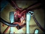 Supra-annular aortic valve replacement with a mechanical prosthesis