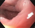 Endoscopic Treatment of Zenker's Diverticulum: Comparable Treatment Outcomes in Treatment-Naïve and Pretreated Patients