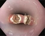 Endoscopic Treatment of Zenker's Diverticulum: Comparable Treatment Outcomes in Treatment-Naïve and Pretreated Patients