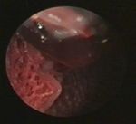 Lung hemorrhage in a green iguana (Iguana iguana) with chronic metabolic failure: a case report