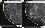 Multimodality Review of Imaging Features Following Breast Reduction Surgery