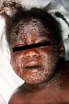 Related to smallpox, but monkeypox virus is far less fatal. It's less transmittable and only occasionally seen in the United States - UMC EMS ...