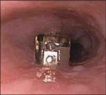 The Diagnosis of Gastroesophageal Reflux Disease