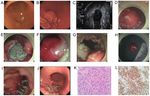 Application of NOTES combined with ESD for the treatment of an exogenous gastric stromal tumor: A case report and review of the literature