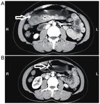 Application of NOTES combined with ESD for the treatment of an exogenous gastric stromal tumor: A case report and review of the literature