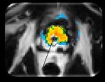 Incision & Radiation-Free Surgery Real-Time MR Guided Ultrasound Therapies CORPORATE PRESENTATION | January 2019 - Profound Medical
