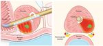 Incision & Radiation-Free Surgery Real-Time MR Guided Ultrasound Therapies CORPORATE PRESENTATION | January 2019 - Profound Medical