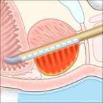 Incision & Radiation-Free Surgery Real-Time MR Guided Ultrasound Therapies CORPORATE PRESENTATION | January 2019 - Profound Medical