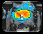 Incision & Radiation-Free Surgery Real-Time MR Guided Ultrasound Therapies CORPORATE PRESENTATION | January 2019 - Profound Medical