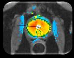 Incision & Radiation-Free Surgery Real-Time MR Guided Ultrasound Therapies CORPORATE PRESENTATION | January 2019 - Profound Medical