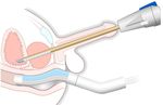 Incision & Radiation-Free Surgery Real-Time MR Guided Ultrasound Therapies CORPORATE PRESENTATION | January 2019 - Profound Medical